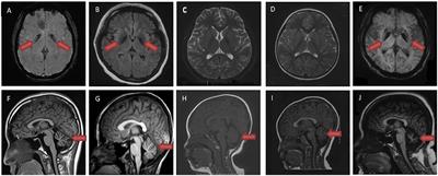 Novel PLA2G6 Pathogenic Variants in Chinese Patients With PLA2G6-Associated Neurodegeneration